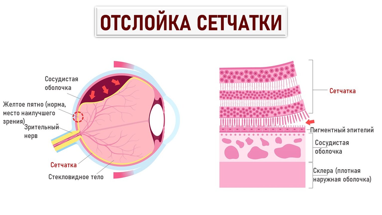 отслойка сетчатки