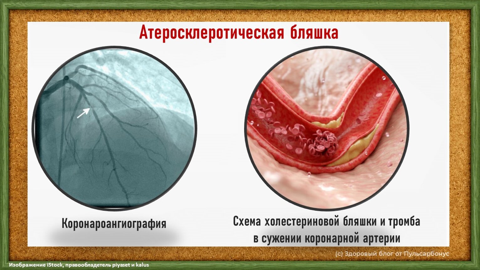 холестериновая бляшка и тромб в коронарной артерии