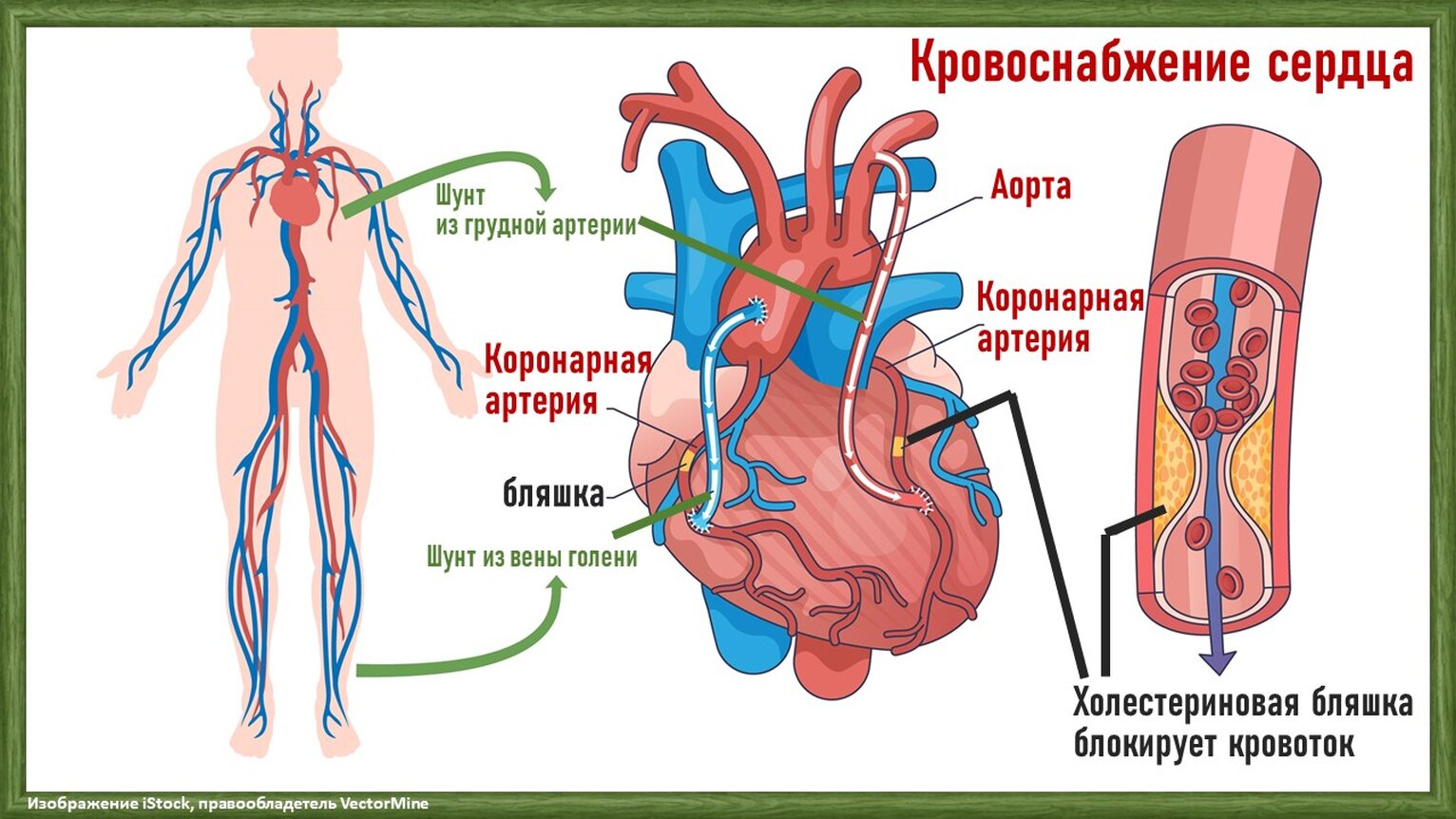 артерии сердца бляшки и шунтирование