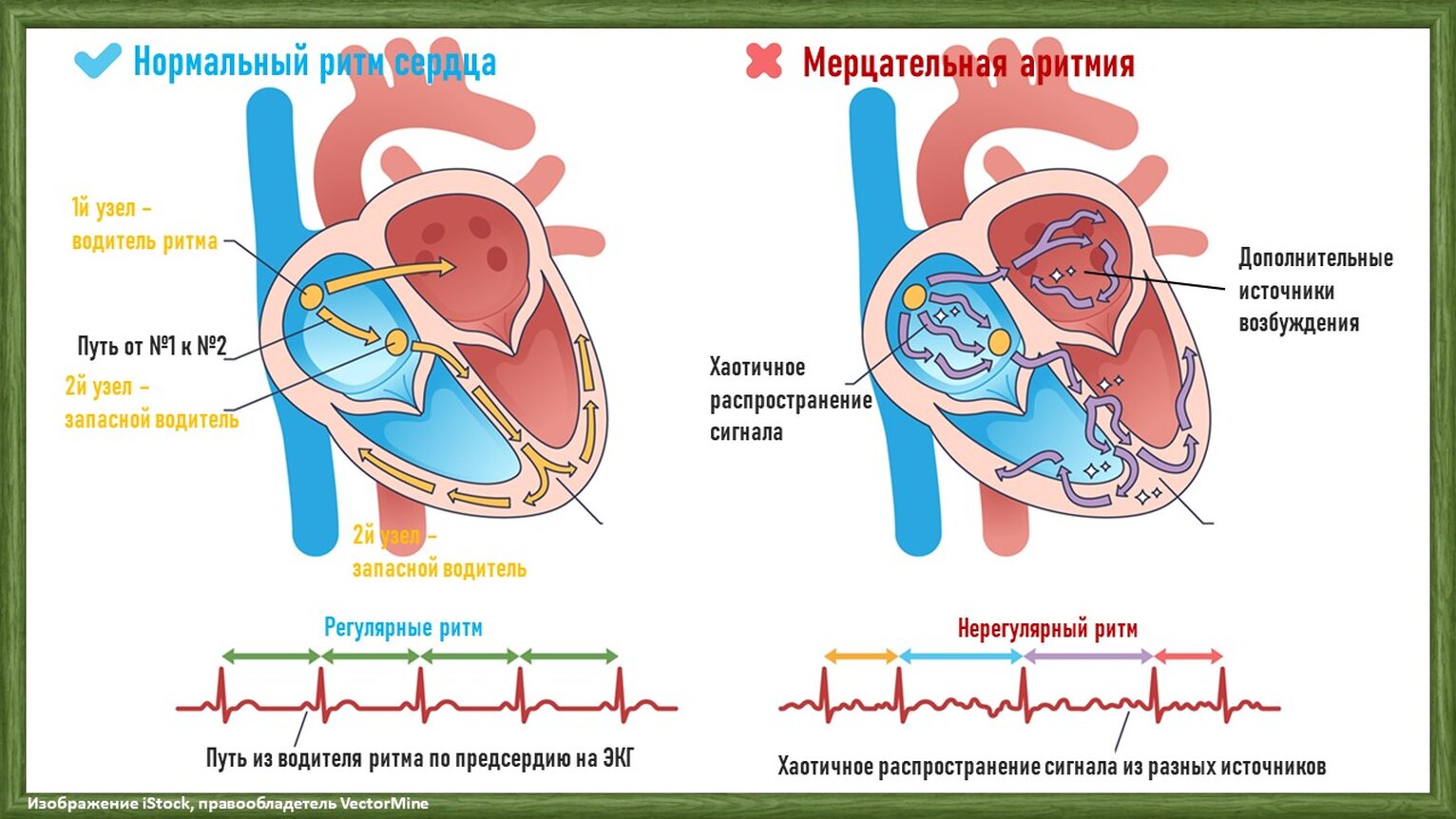 мерцательная аритмия объяснение пациенту